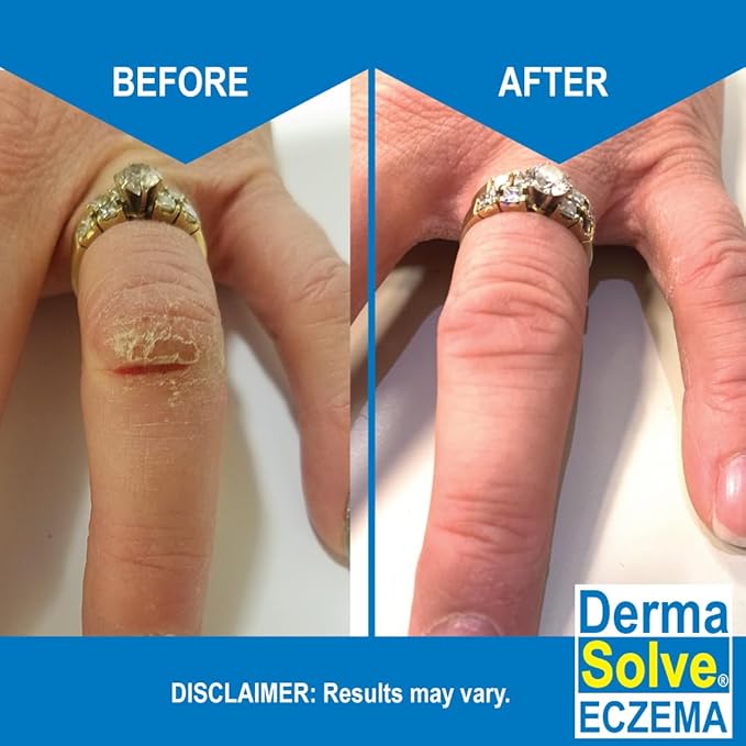 Dermasolve Eczema Relief Body Wash (2 Pack) | Protects, Moisturizes, and Repairs Skin - Kids, Babies & Adults - Steroid Free-CubbioJoy