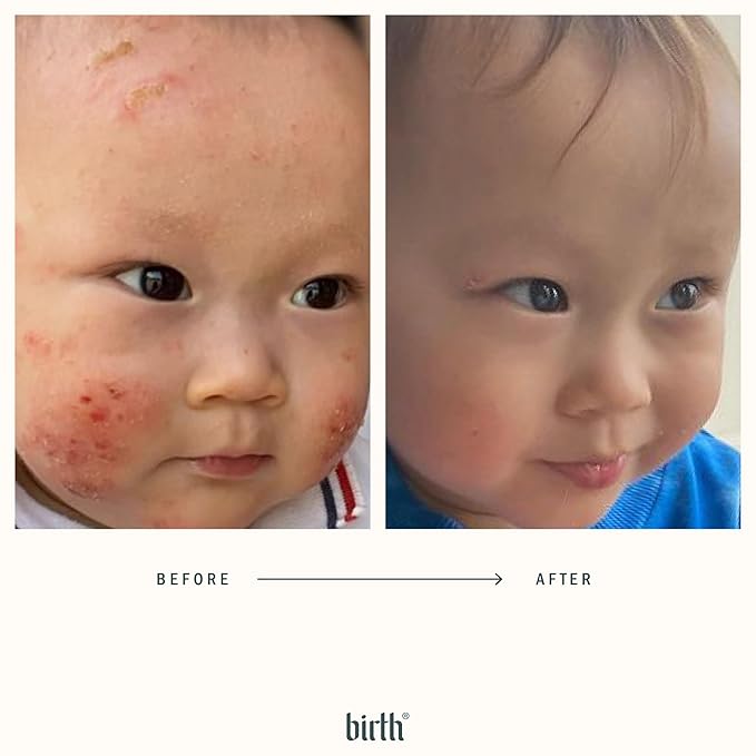 BIRTH SKINCARE Eczema Organic Baby Serum for Newborn and Infant, Redness Relief Moisturizer for Dry skin, Steroid Free 20z 59 ml Baby Ointment Body Serum for itchy Skin Relief, Made In Canada-CubbioJoy